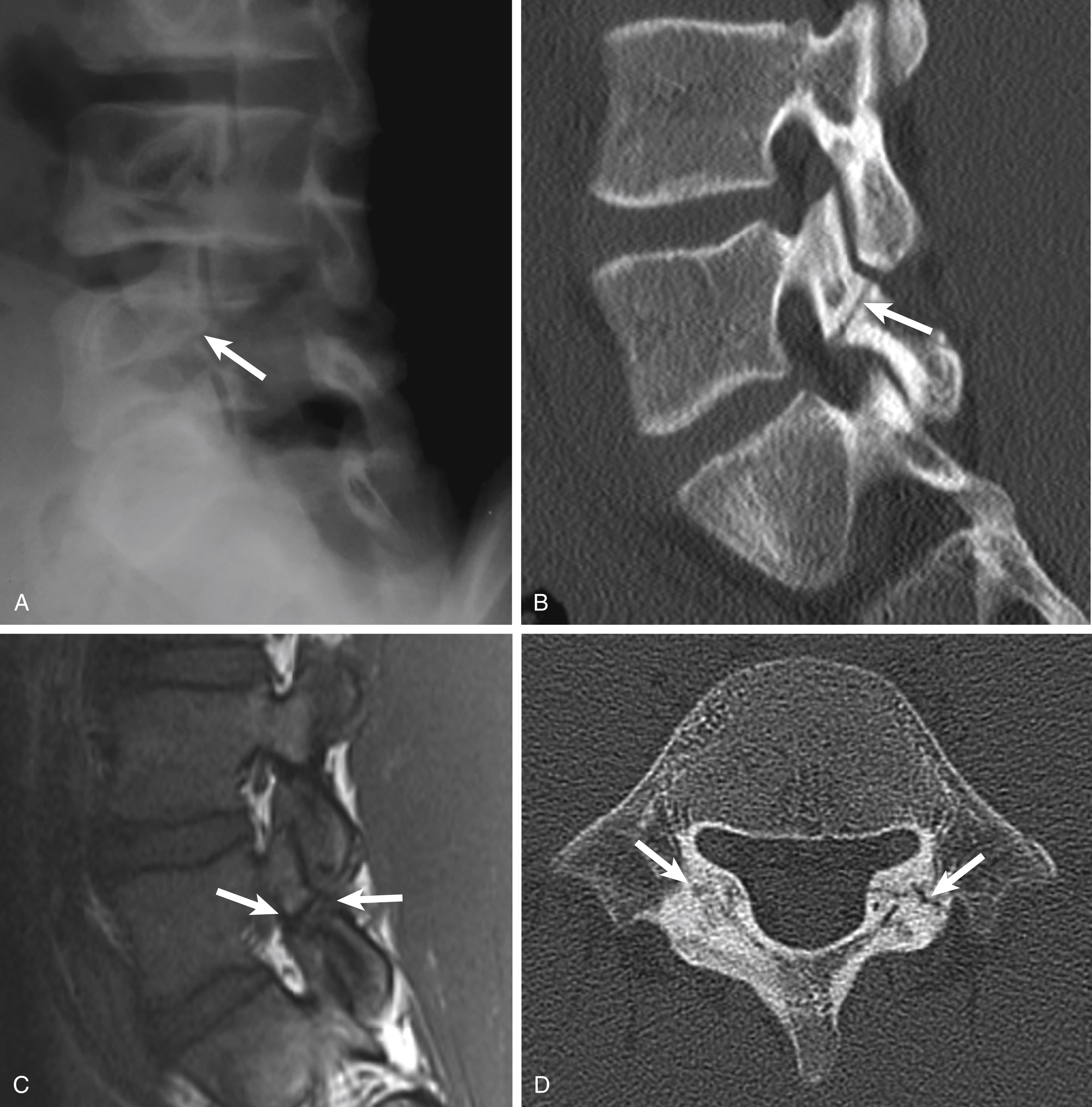 Fig. 30.3, Chronic bilateral L5 spondylolysis in a 16-year-old.