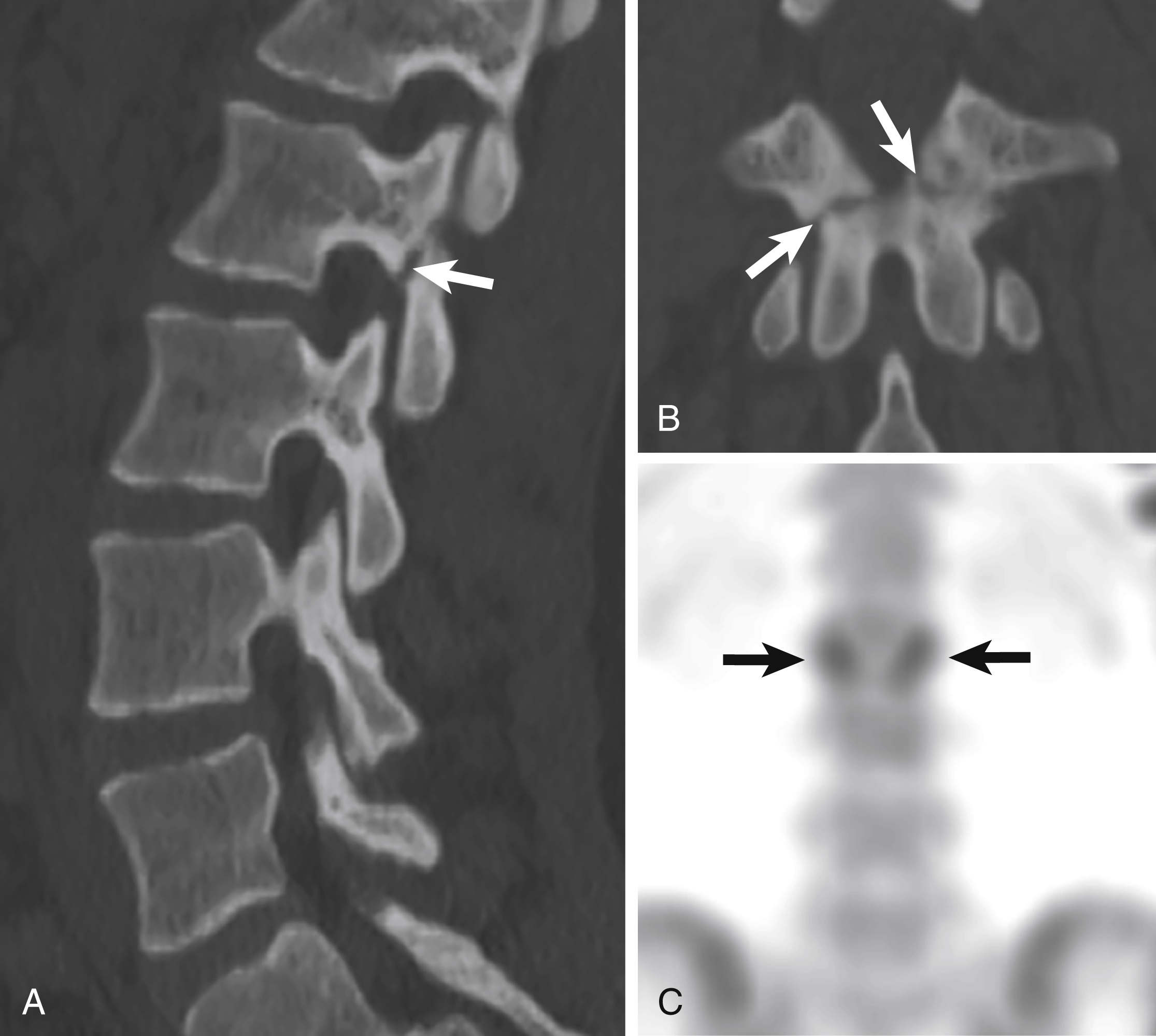 Fig. 30.4, Acute bilateral L2 spondylolysis in a 14-year-old.