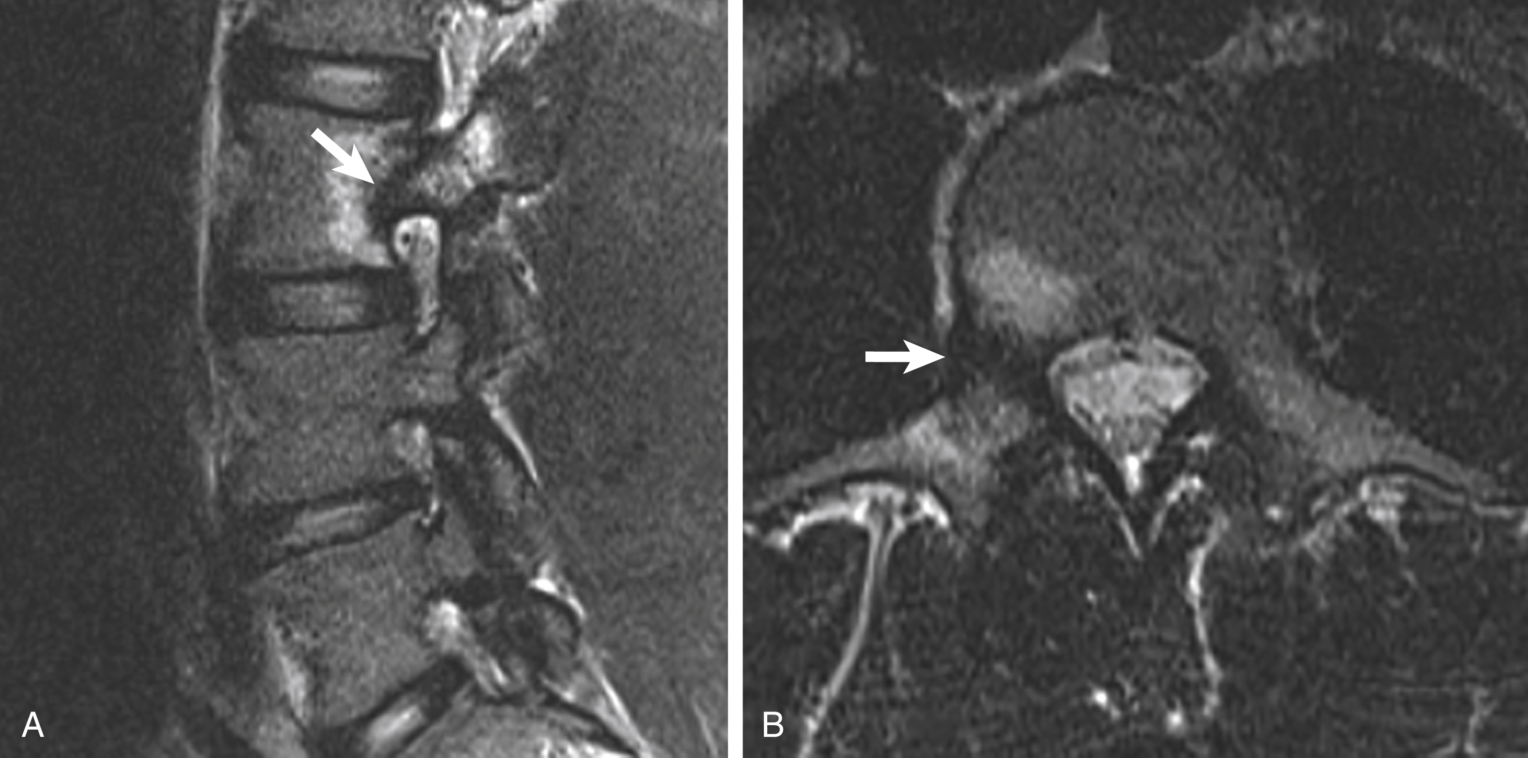 Fig. 30.5, Acute fracture of the right L3 pedicle in a 16-year-old.