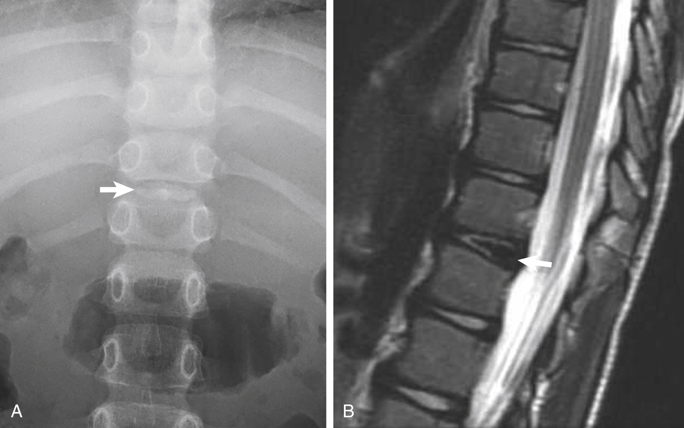 Fig. 30.6, Disk calcification in a 6-year-old boy.