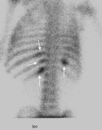 Figure 91-1, Rib fractures due to NAT on technetium-99m ( 99m Tc) methylene diphosphonate (MDP) bone scan. Posterior view demonstrates multiple foci of radiotracer uptake in posterior inferior ribs ( arrows ).