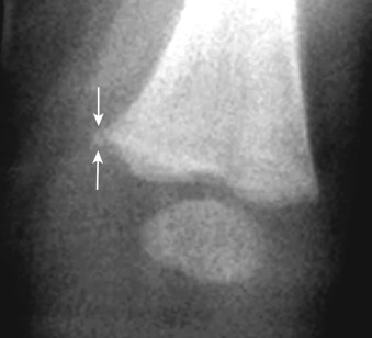 Figure 91-2, Metaphyseal corner fracture of distal tibia due to NAT on frontal radiograph. Note typical linear lucency ( arrows ) within peripheral subphyseal metaphysis.