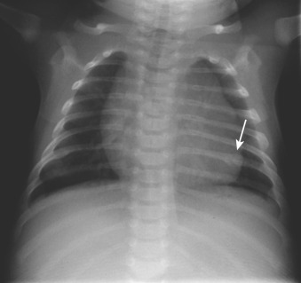 Figure 91-3, Posterior rib fractures due to NAT on frontal chest radiograph. Note curvilinear lucency in posterior left 7th rib with surrounding callus formation ( arrow ) due to partially healed fracture. Also note mild deformity of contralateral right posterior 7th rib indicating separate healed fracture.