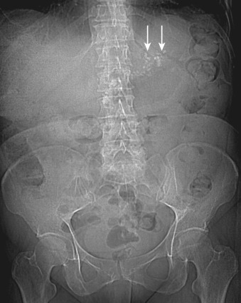 Figure 49-1, Diffuse coarse irregular calcification (arrows) in the upper abdomen in the expected location of the pancreas suggestive of chronic pancreatitis.