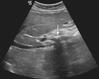 Figure 49-2, Ultrasound image of abdomen shows dense calcification within pancreatic body (arrow) with posterior acoustic shadowing consistent with chronic calcific pancreatitis.