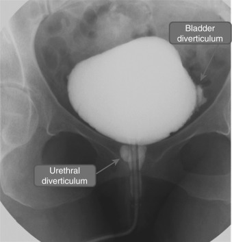 Figure 79-1, Voiding urethrocystogram shows urethral and urinary bladder diverticula.