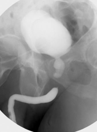 Figure 80-1, Combined retrograde urethrography and micturition cystourethrography demonstrates complete transection of the urethra with stricture formation.