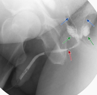 Figure 80-2, Retrograde urethrography demonstrates stricture of the membranous urethra ( red arrow ) with reflux of contrast medium into the seminal vesicles ( green arrows ) and vas deferens ( blue arrows ).