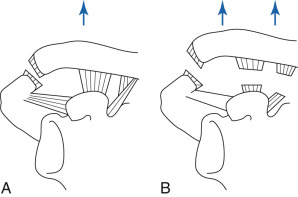 Figure 45-1, A, Schematic image of Type II AC joint separation. Only AC ligament is ruptured. B, Schematic image of Type III AC joint separation. There is complete tear of AC and coracoclavicular ligaments.