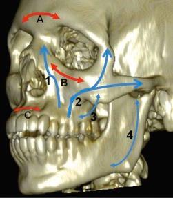 eFIGURE 3–1, The buttresses are lines of osseous thickening that help support the form and masticatory function of the face. The buttresses increase the strength of the facial bones but also create areas of weakness prone to fracture. Blue arrows indicate the vertical buttresses: 1, nasomaxillary; 2, zygomaticomaxillary, 3, pterygomaxillary; 4, mandible. Red arrows indicate the horizontal buttresses: A, frontal bar, B, inferior orbital rim; C, hard palate.