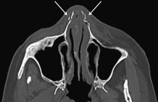 FIGURE 3–1, Bilateral nasal bone fractures. There is severe comminution on the left and an overriding nasal bone fragment on the right (arrows) . Note how the smooth skin contour, although displaced slightly by soft tissue swelling underneath, is so symmetric that it may obscure the degree of osseous injury on clinical inspection. The generalized swelling effaces the anterior nasal lumen. In addition, the presence of gas in the soft tissues seen in the setting of acute trauma suggests some laceration of nearby soft tissues.