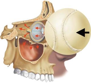 FIGURE 3–2, Illustration of mechanism of orbital blowout fracture. Forces are transmitted to the orbital region in two waves. First, the relatively smaller orbital rim absorbs the impact of an object and forces propagate posteriorly in an osseous wave. This leads to fragmentation of the weak inferior and/or medial walls of the orbit, apparently the weakest aspects of the orbit. A separate pressure wave results from forces that are initially absorbed by compression of the orbit, then released into the soft tissues after orbital recoil. This soft tissue wave causes displacement of the fragments that had been created by the osseous wave.