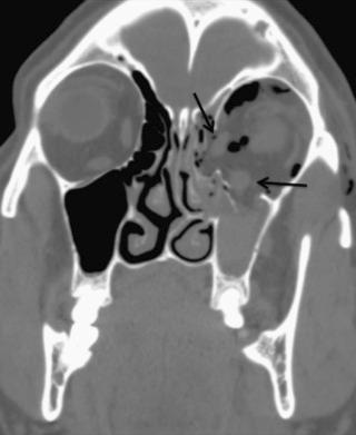 FIGURE 3–4, A 29-year-old man with fractures of the orbital floor and lamina papyracea with extensive orbital emphysema, herniation of the orbital fat, and inferior rectus and medial rectus muscles. Note the deformity of the muscle bellies suggesting intramuscular hematoma or edema (arrows) . (See Video 3-2 for the full study.)