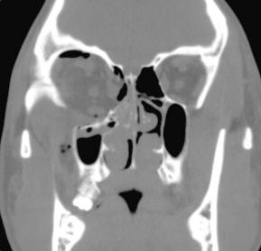 eFIGURE 3–4, A 23-year-old man with fractures of the right orbital floor and lamina papyracea. There is herniation of muscle and fat into the maxillary sinus and ethmoid air cells, respectively. The orbital floor fracture traverses the infraorbital, foramen and the patient did not recover sensation over the right cheek for 6 months. (See Video 3-10 for the full study.)