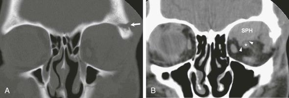 FIGURE 3–6, Fracture of the lateral orbital roof with subperiosteal hematoma. A , Bone windows show a displaced fracture fragment from the left superolateral orbital rim (arrow) . B , Soft tissue windows show a soft tissue density indistinguishable from the superior muscle complex, representing subperiosteal hematoma (SPH) . Note the thin cleft of fat (arrowheads) between the hematoma and otherwise normal-appearing optic nerve (asterisk) . The superior rectus and superior oblique muscles are not independently identified. Such a hematoma can result in downward displacement of the conal structures and associated diplopia. If not evacuated, this hematoma may eventually ossify.