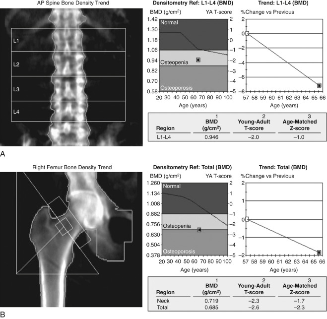 Figure 48-1, Osteopenia and osteoporosis on DXA scan. A, T-score for lumbar spine is −2.0, in keeping with osteopenia. B, T-score for right hip is −2.6, in keeping with osteoporosis.