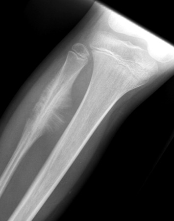 Figure 51-1, Osteosarcoma on radiograph. Note aggressive lesion of proximal fibula with sunburst or “hair-on-end” periosteal reaction.