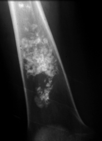 Figure 51-2, Enchondroma on radiograph. Note lesion in femur with presence of ringlike, flocculent, or flecklike matrix in shape of rings and arcs indicative of cartilage matrix.