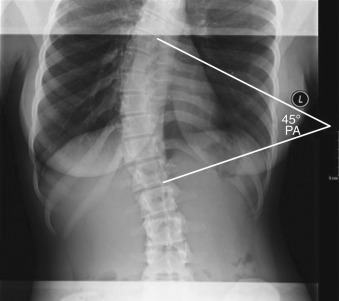 Figure 47-1, Dextroscoliosis of thoracolumbar spine on frontal radiograph. Note curvature of thoracolumbar spine with convexity to right and with Cobb angle of 45 degrees.