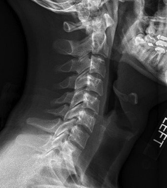 Figure 47-2, Normal cervical lordosis on lateral radiograph. Note gentle curvature of cervical spine with anterior convexity.