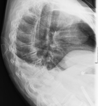 Figure 47-3, Kyphosis of thoracic spine on lateral radiograph. Note curvature of thoracic spine that is more exaggerated than normal with posterior convexity.