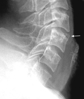 Figure 47-4, Limbus vertebra of cervical spine on lateral radiograph. Note triangle-shaped, well-corticated ossicle at anterior-superior endplate of C5 vertebra ( arrow ) that is separated from remainder of vertebral body by linear lucency caused by intervening disc material.