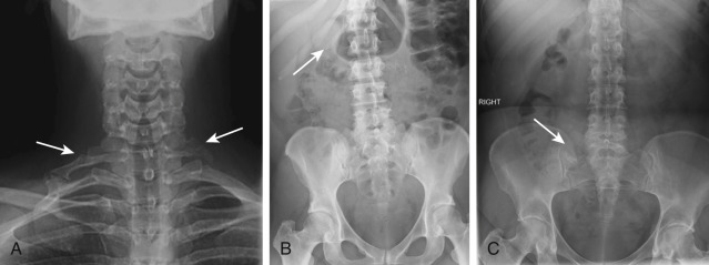 Figure 47-6, A, Cervical ribs on frontal radiograph. Note small bilateral ribs, right larger than left ( arrows ), arising from C7 vertebra. B, Lumbar rib on frontal radiograph. Note small right rib arising from L1 vertebra ( arrow ). C, Transitional vertebra of lumbosacral spine on frontal radiograph. Note partial sacralization of lowest lumbar vertebra ( arrow ) where right transverse process articulates with sacrum and left transverse process of same vertebra is thickened.