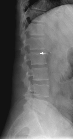 Figure 47-7, Schmorl's node of lumbar spine on lateral radiograph. Note lucent indentation along superior endplate of L2 vertebral body with surrounding sclerosis ( arrow ) due to intervertebral disc herniation through vertebral endplate.