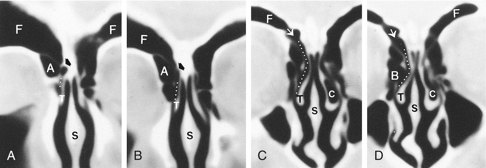 Fig. 38.2, Anatomy of the frontal sinus.