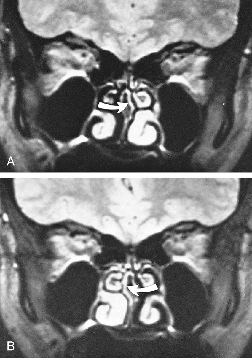 Fig. 38.3, Nasal cycle.