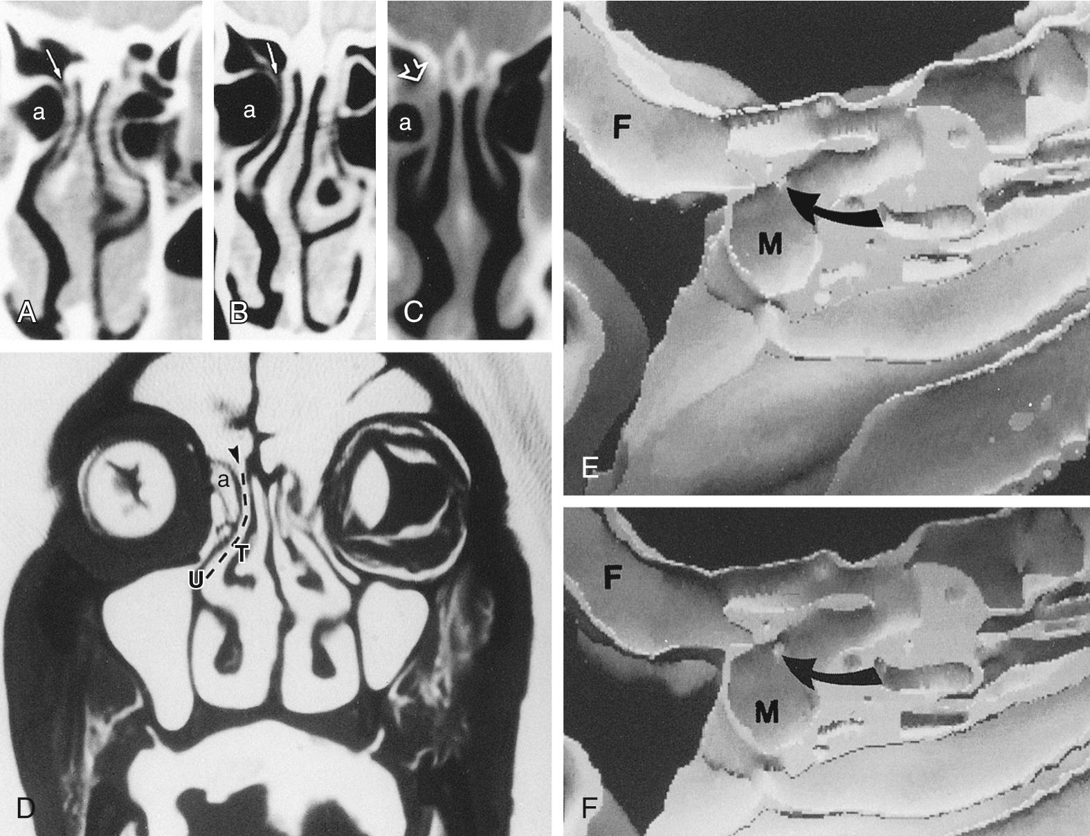 Fig. 38.4, Anatomy of the frontal recess.