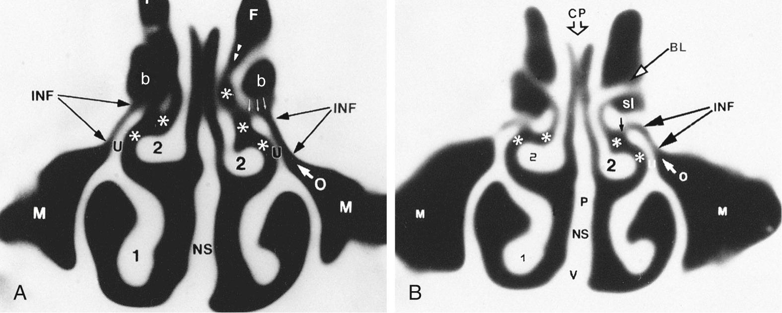 Fig. 38.5, Anterior ostiomeatal channels.