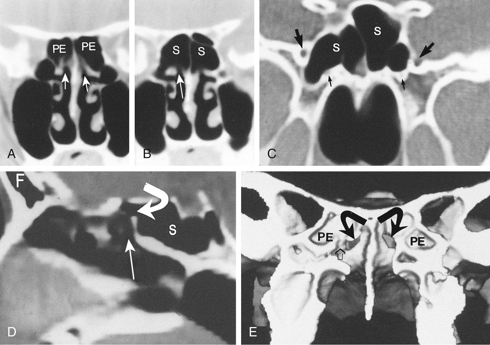 Fig. 38.6, The sphenoid sinus anatomy.