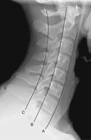 Figure 46-1, Normal cervical spine on lateral radiograph. Cervical vertebrae to C7-T1 can be visualized. Four parallel lines used for assessment of alignment are drawn: A, anterior vertebral line; B, posterior vertebral line; C, spinolaminar line; and D, posterior spinous line.