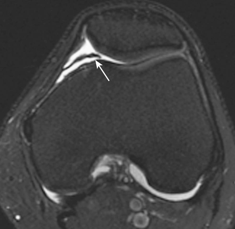 FIG 9.1, Medial Patellar Plica