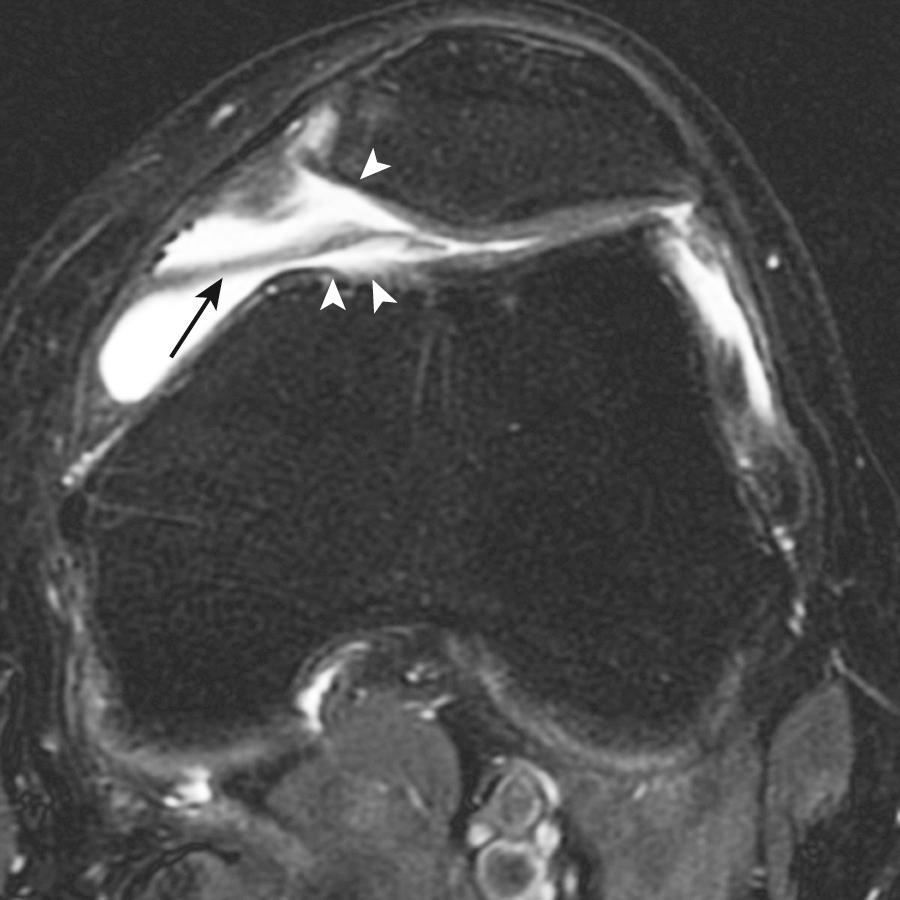 FIG 9.2, Fibrotic Medial Patellar Plica