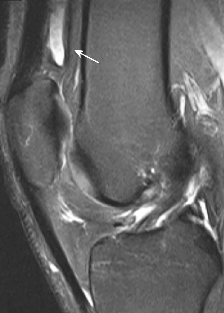 FIG 9.3, Obstructing Suprapatellar Plica