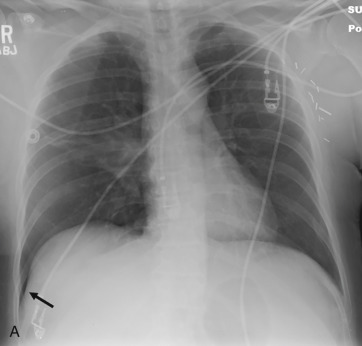 Figure 43.1, (A) Supine frontal radiograph in a patient involved in a motor vehicle collision demonstrates a hyperlucent and deep right costophrenic angle (arrow). This finding, known as the deep sulcus sign, occurs when gas within a pneumothorax collects inferiorly in a supine patient. (B) Image of the same patient taken 1 hour later shows that the patient now has a large right pneumothorax, with collapse of the right lung toward the hilum (arrow). There is no tension effect, however, because the mediastinum remains centered, and the right hemidiaphragm is not displaced. (C) In a different patient, status post–gunshot wound to the left chest, the left chest is opacified secondary to the presence of a large tension hemopneumothorax. The tension hemopneumothorax displaces the mediastinum to the right and the left hemidiaphragm inferiorly.