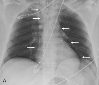 Figure 43.2, (A) Supine radiograph in a patient status post–motor vehicle collision shows vertical lucencies about the mediastinum (arrows), consistent with pneumomediastinum. Note that the left heart border is outlined with gas, which has tracked inferiorly and can be difficult to distinguish from pneumopericardium. (B) An image from the CT of this patient confirms the presence of pneumomediastinum in the anterior mediastinum. Note that the gas in pneumomediastinum is insinuating among the mediastinal fat, which can be seen as displaced islands of increased density (arrow). (C) Image in a different patient who was stabbed in the chest also shows gas outlining the heart (arrows), but note the absence of gas more superiorly in the mediastinum. (D) An image from the CT scan of this patient shows gas in the pericardium (arrow), consistent with pneumopericardium. Note that in contrast to the gas shown in (B), which was present in the potential space of the mediastinum, this gas is present in a true space (the pericardial space) and does not have islands of fat or strands of tissue within it. Given the presence of pneumopericardium, the patient underwent surgical exploration, which found a pericardial defect but no evidence of myocardial injury.