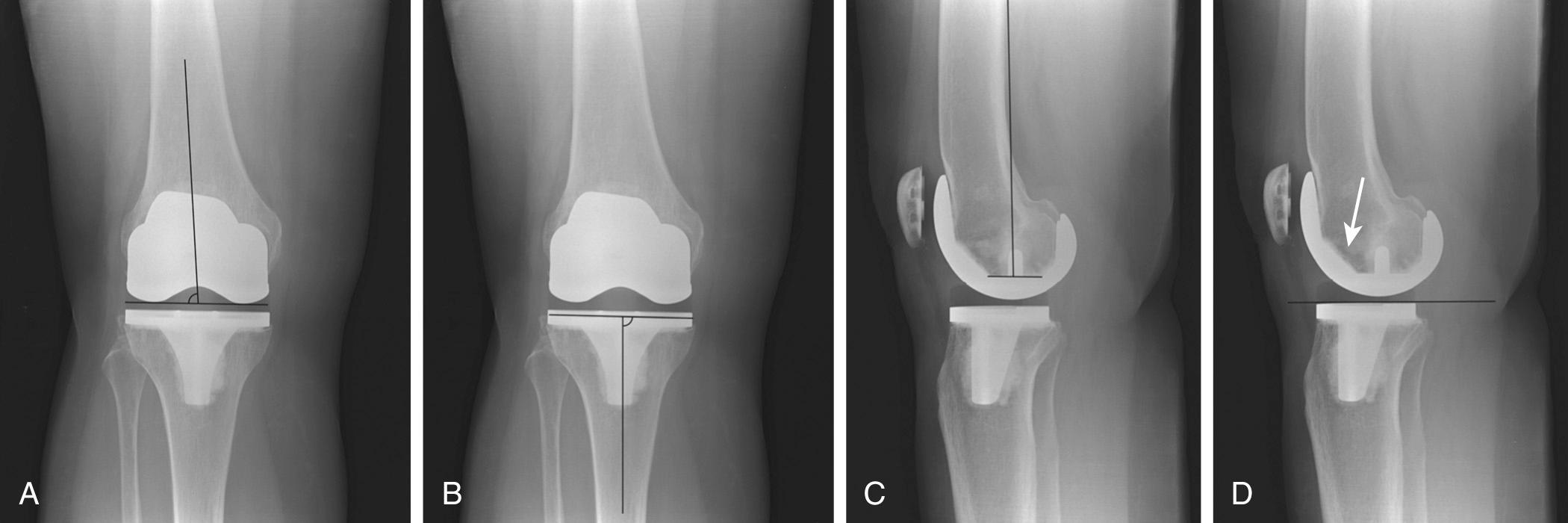 FIG 13.1, Normal Component Positioning on Standing Knee Radiographs