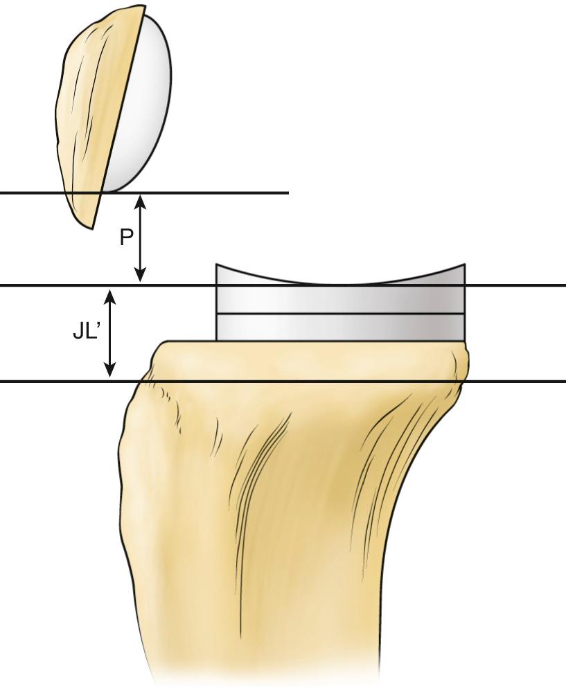 FIG 13.3, Assessing Joint Line and Patellar Height