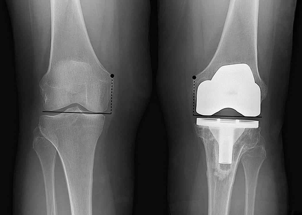 FIG 13.4, Anteroposterior Method of Measuring the Joint Line According to Hofmann and Associates