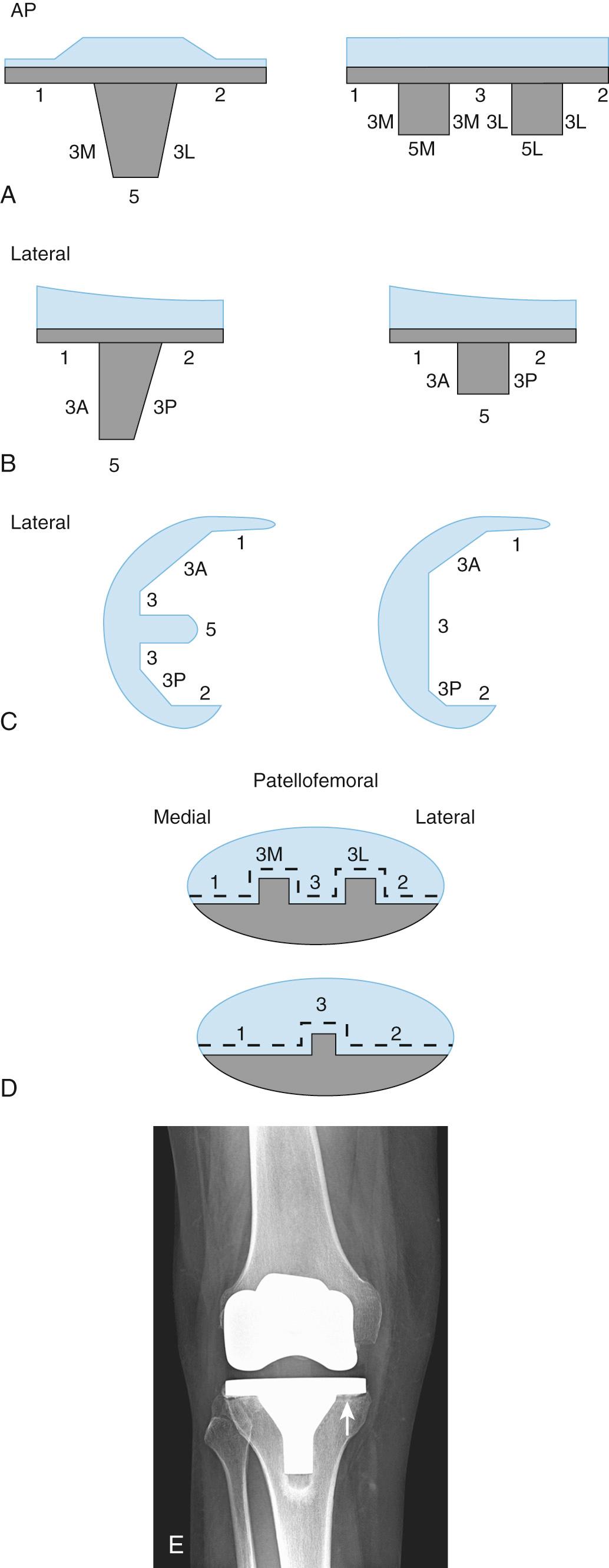 FIG 13.5, (A) Coronal and (B) sagittal radiographic schematic of keeled and two-peg implants with zones for documentation of radiolucent lines and osteolysis. (C) Sagittal plane radiographic schematic of femoral implant with zones denoted for radiolucent lines and osteolysis. (D) Patellofemoral view radiographic schematic of multi- or single-peg patella implant with zones denoted for documentation radiolucent lines and osteolysis. Radiolucent lines should be denoted and documented as “partial” or “complete” and osteolysis documented in millimeters. (E) Less than 2 mm lucent line is present under the medial and lateral tibial baseplate with an adjacent thin sclerotic line (arrow). Such lucencies are seen in asymptomatic patients. (A-D from Meneghini RM, Mont MA, Backstein DB, et al: Development of a modern knee society radiographic evaluation system and methodology for total knee arthroplasty. J Arthroplasty 30:2311–2314, 2015.)