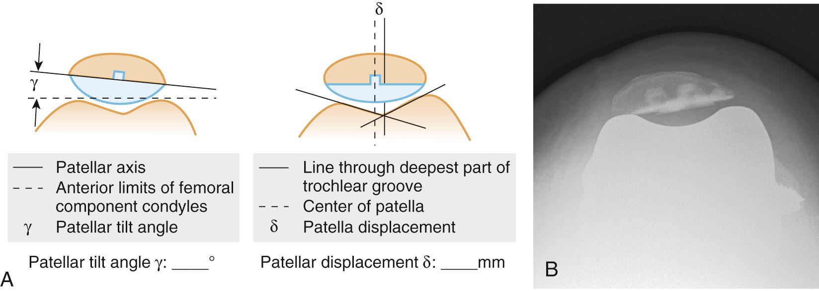 FIG 13.6, Patellar Displacement and Patellar Tilt