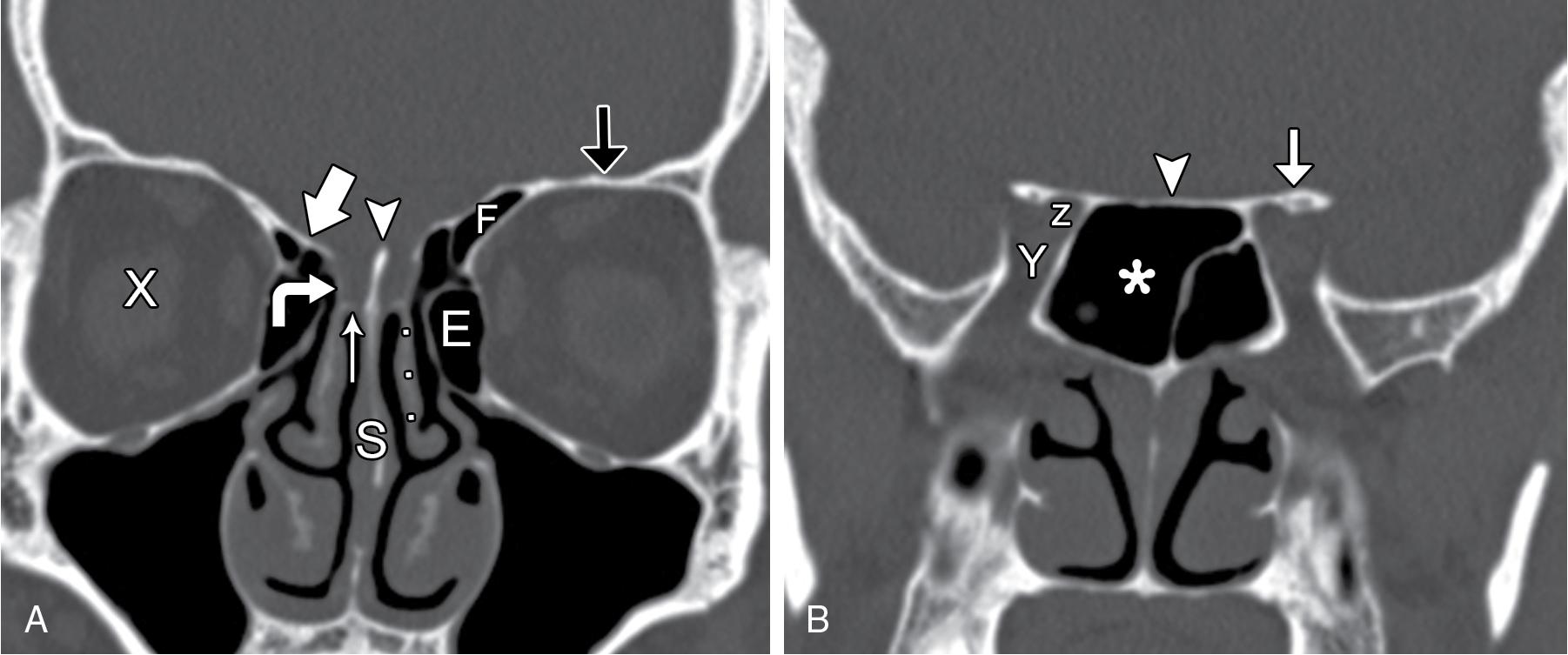 Fig. 11.1, Coronal computed tomography images demonstrate normal skull base anatomy. A, Anterior image: E, Anterior ethmoid sinus; F, frontal sinus; S, nasal septum; X, orbit; wide arrow, fovea ethmoidalis; curved arrow, lateral lamella of cribriform plate; narrow arrow, medial cribriform plate; arrowhead, crista galli; black arrow, orbital roof; ... , middle turbinate. B, Posterior image: Y, Superior orbital fissure; z, optic canal; arrowhead, planum sphenoidale; arrow, lesser wing of the sphenoid; asterisk, sphenoid sinus.