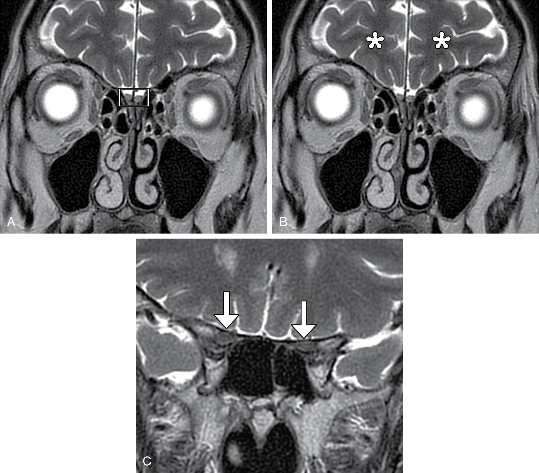 Fig. 11.2, Coronal T2-weighted magnetic resonance images show the olfactory bulbs (box) ( A ), frontal lobes (*) ( B ), and optic nerves in the optic canals (arrows) ( C ).