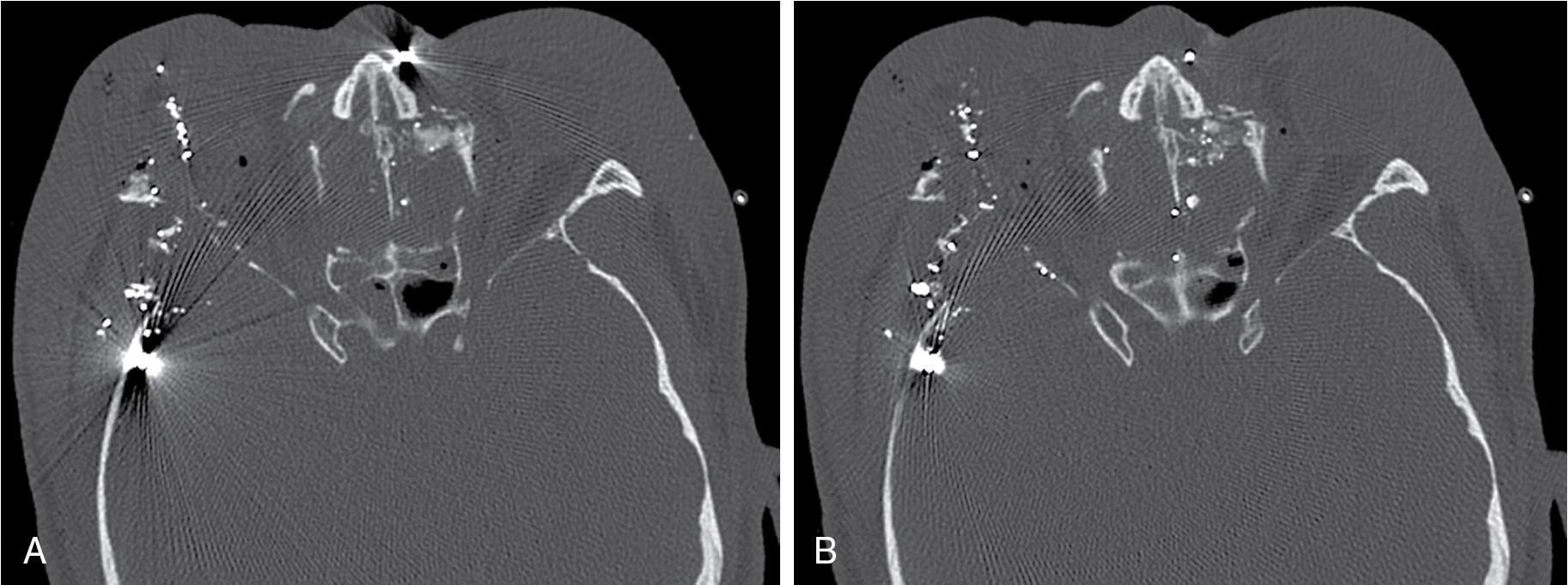 Fig. 11.3, Axial computed tomography images show the difference in the extent of streak artifact from bullet fragments without ( A ) and with ( B ) metal artifact reduction software.