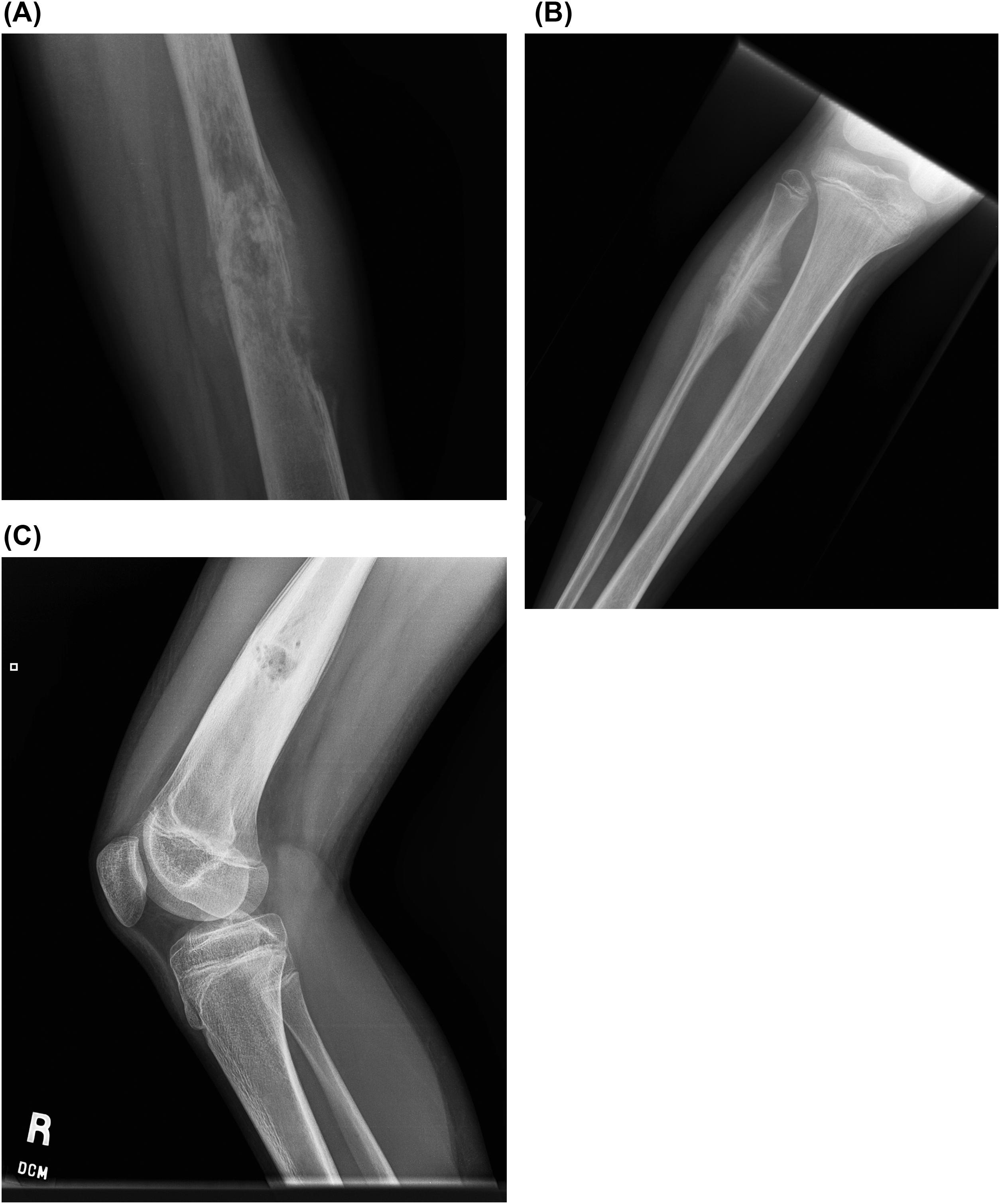 Figure 46.1, (A) A lateral radiograph of the femur with an aggressive, destructive osteoid-producing lesion with associated ossification of only the raised edge of the periosteum inferiorly at the right of the image, creating a Codman's triangle appearance in a patient with an osteosarcoma. (B) A frontal radiograph of the tibia-fibula with sunburst periosteal reaction involving the proximal fibular diaphysis with periosteum radiating outward like rays of the sun, and this was another case of osteosarcoma. (C) A lateral radiograph of the knee with a lytic lesion in the distal femoral diaphysis with surrounding sclerosis and associated multilamellated, or multilayered, periosteal reaction which is best demonstrated anteriorly. This was related to osteomyelitis.