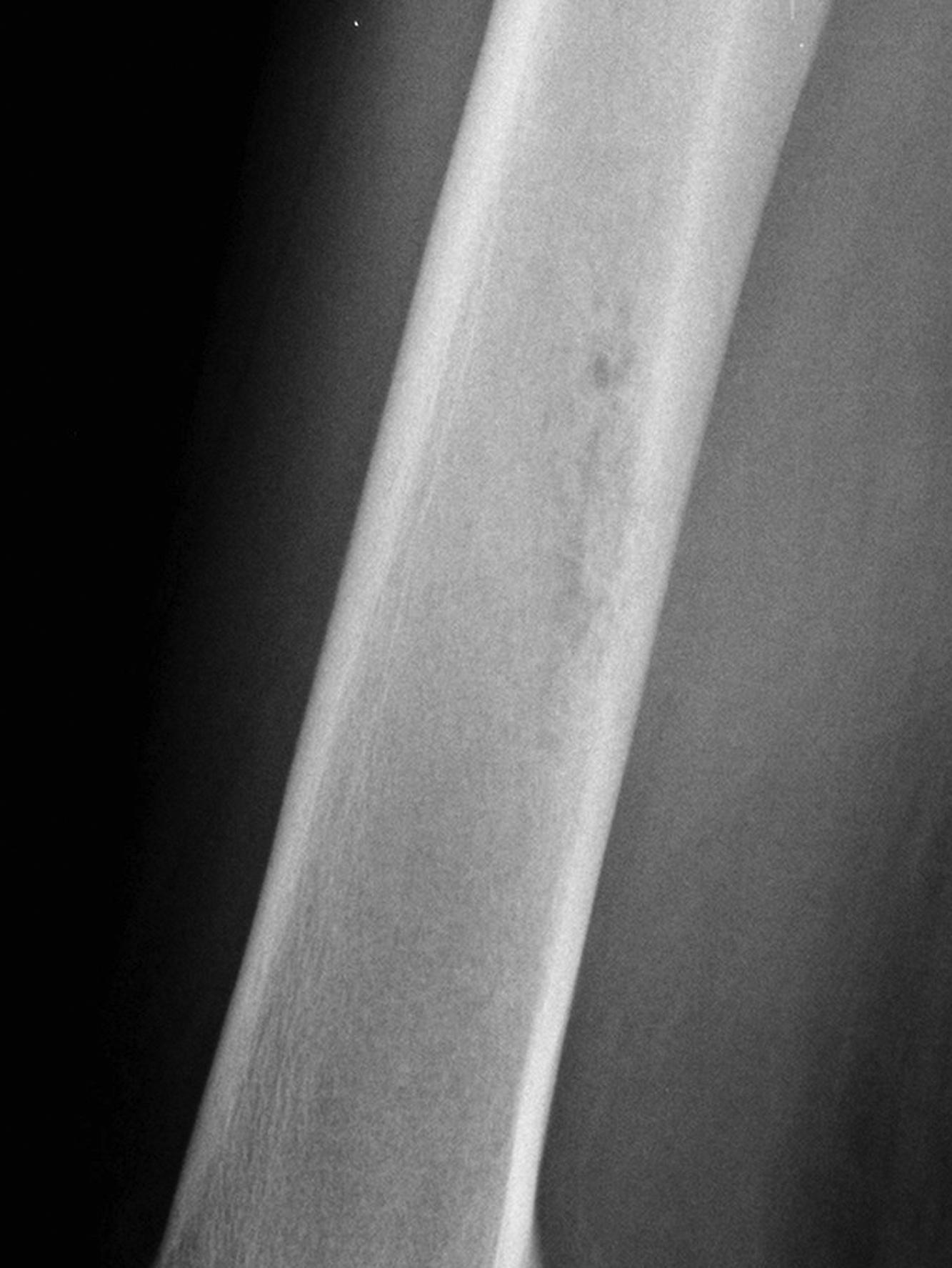 Figure 46.2, A coned down radiograph of the distal femoral diaphysis with a lytic, permeative pattern of destruction and ill-defined margins, a sign of an aggressive underlying bony process. This patient had osteomyelitis.