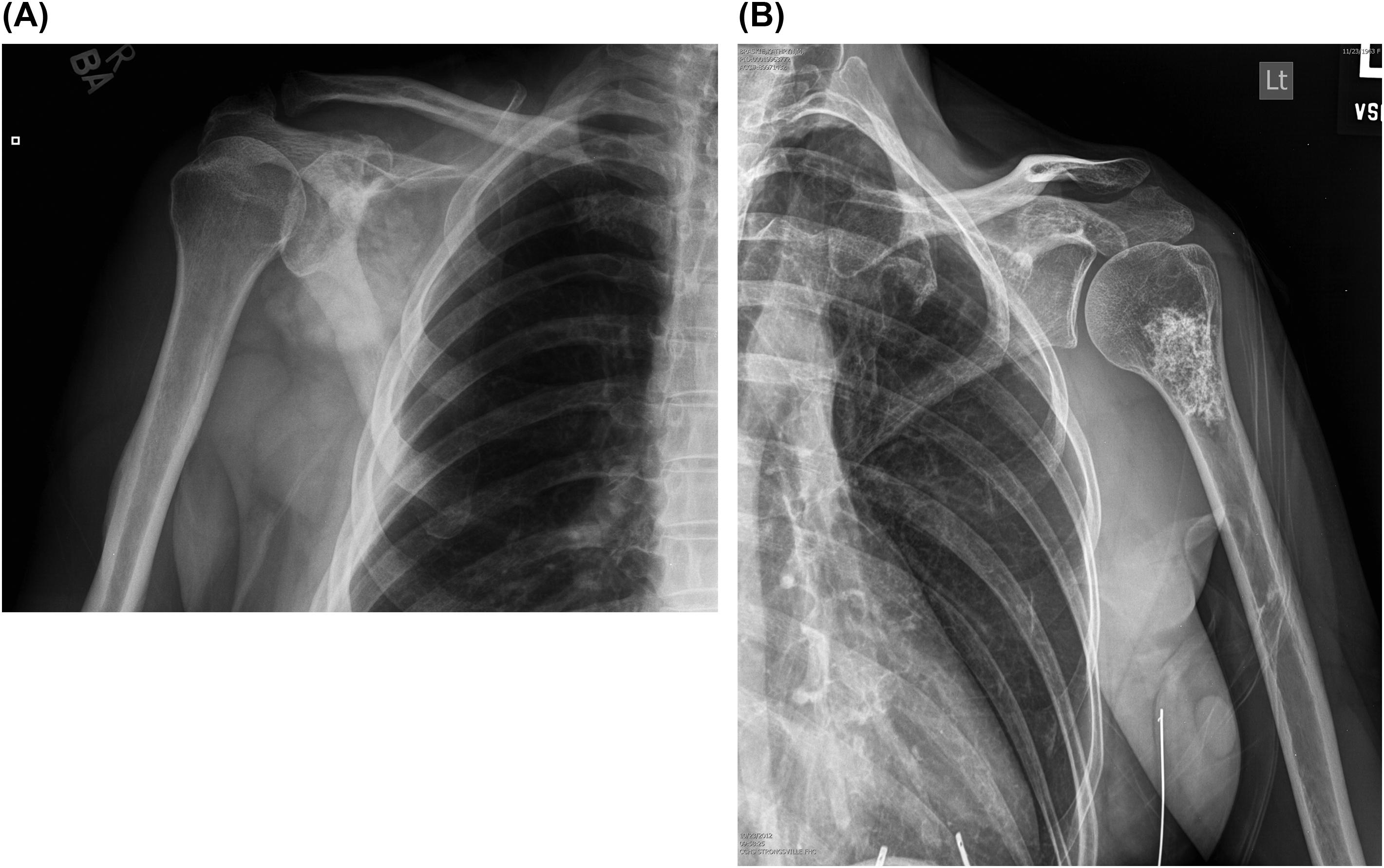 Figure 46.3, (A) A frontal radiograph of the right shoulder with fluffy, cloud-like osteoid mineralization of an osteosarcoma overlying the lateral inferior scapula. (B) Contrast that with the classically described “rings and arcs” chondroid mineralization of an enchondroma seen in the proximal humerus on a frontal radiograph of the left shoulder.